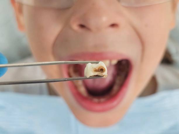 Best Emergency Root Canal Treatment in Rock Hill, MO
